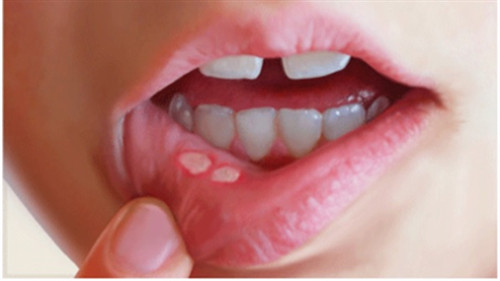 Mùa hè - Mùa "nở rộ" các bệnh về răng miệng: Giải pháp phòng ngừa và chăm sóc hiệu quả